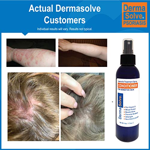 Dermasolve Psoriasis LeaveInTreatment and Styling Spray Conditioner for Seborrheic Dermatitis